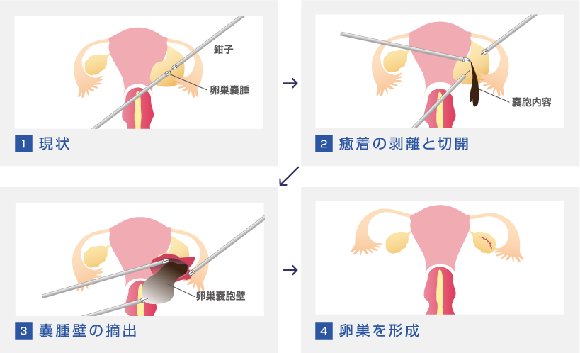 婦人科疾患 札幌白石産科婦人科病院 腹腔鏡手術 子宮内膜症専門外来サイト