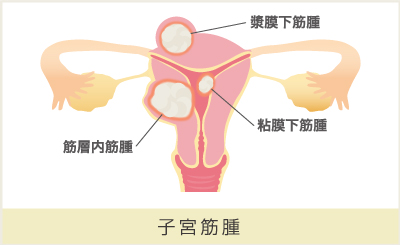 婦人科疾患 札幌白石産科婦人科病院 腹腔鏡手術 子宮内膜症専門外来サイト