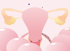 子宮内膜症の進行 stage1