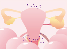 子宮内膜症の進行 stage2
